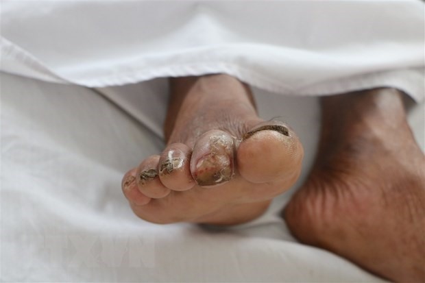 Chân của một bệnh nhân mắc bệnh Whitmore. (Nguồn: TTXVN)