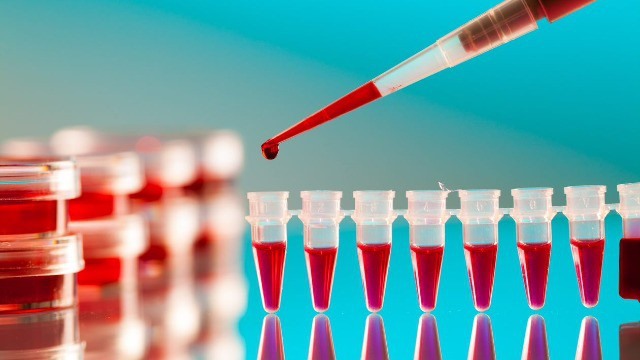 Dịch vụ Y tế Quốc gia của Vương quốc Anh sẽ cho thí điểm một loại xét nghiệm máu đơn giản có thể phát hiện hơn 50 loại ung thư.