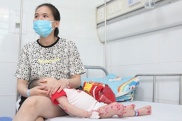 Trẻ mắc bệnh tay chân miệng đang điều trị tại Bệnh viện Nhi Trung ương. (Ảnh: PV/Vietnam+)