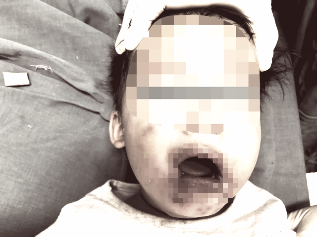 Hình ảnh tổn thương bỏng vùng miệng của bé gái 2 tuổi sau khi đã được điều trị. Ảnh: BVCC