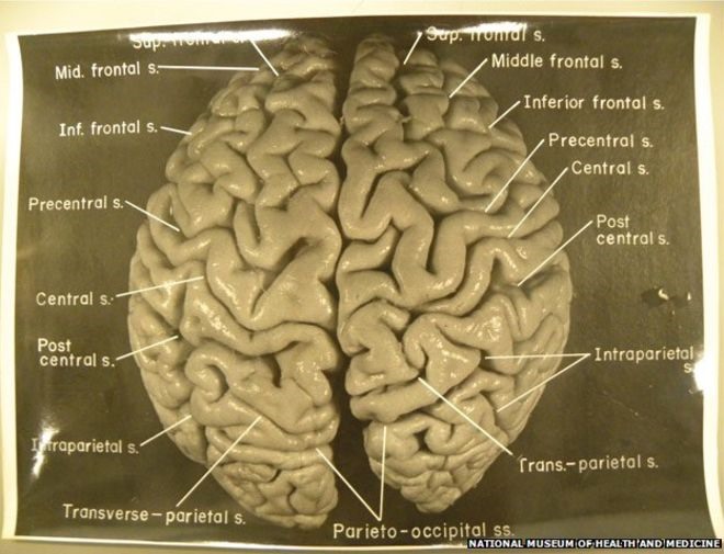 Bộ não của Albert Einstein trước khi được mổ xẻ vào năm 1955. Ảnh: Bảo tàng Y tế và Sức khỏe Quốc gia
