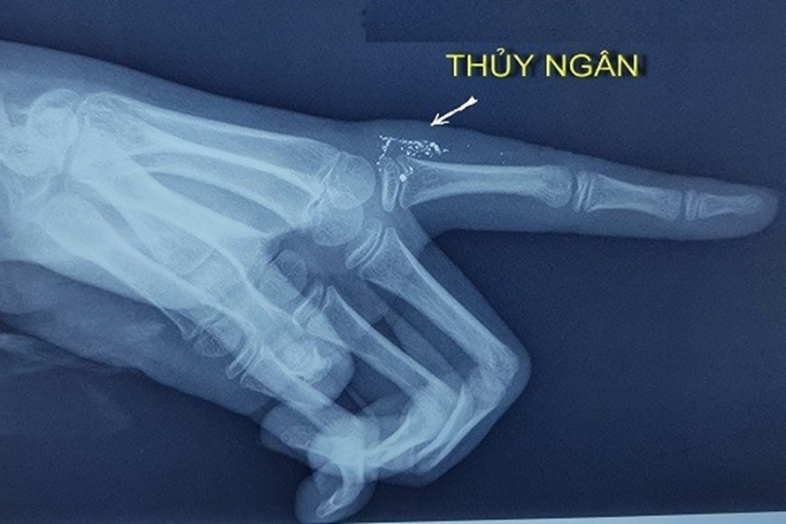 Hạt thủy ngân trong tay qua hình ảnh phim X-quang. Ảnh BVCC
