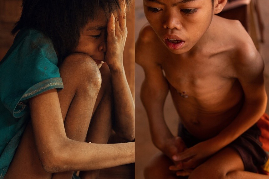 Hai trẻ em bị dị tật bẩm sinh tại khu vực biên giới phía đông của Lào. Ảnh: New York Times.