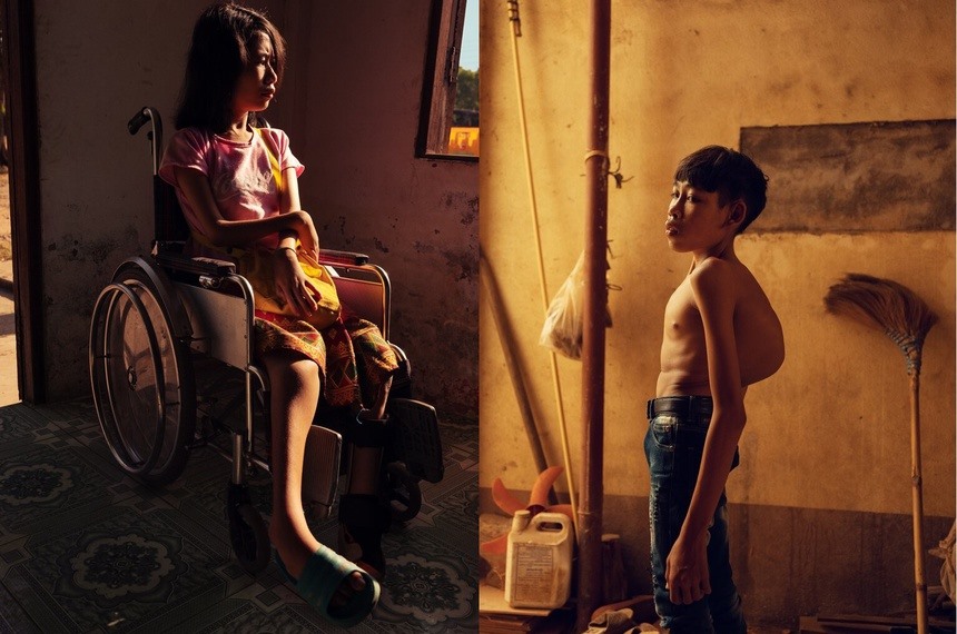 Các trẻ em Lào dị tật bẩm sinh bị nghi do ảnh hưởng của chất da cam. Ảnh: New York Times.
