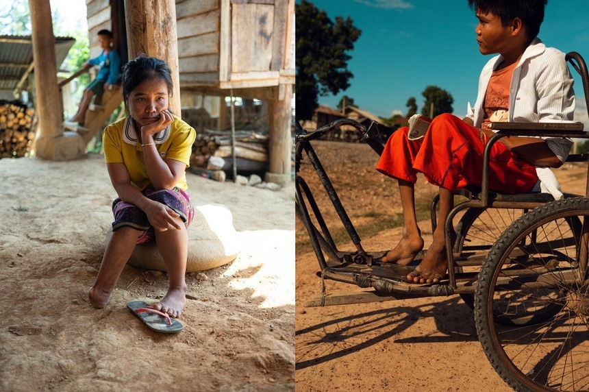 Những người tại Lào bị khuyết tật ở chân, nghi do ảnh hưởng của chất da cam. Ảnh: New York Times.