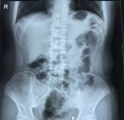 Hình ảnh chụp Xquang cho thấy vị trí các phủ tạng đối lập so với người bình thường.