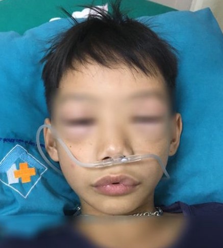 Bé trai bị sốc phản vệ sau khi uống thuốc chữa ho, sốt.