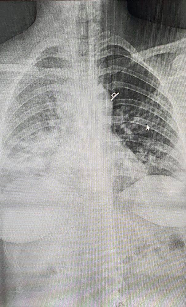 Hình ảnh X-quang phổi của sản phụ. Ảnh: Bộ Y tế