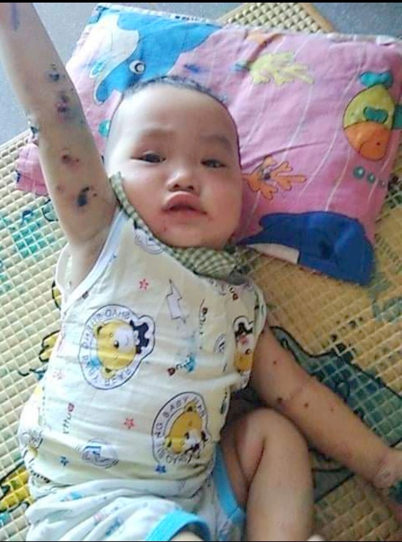 Các bọng nước xuất hiện khắp người cháu Khôi - Ảnh: K.S