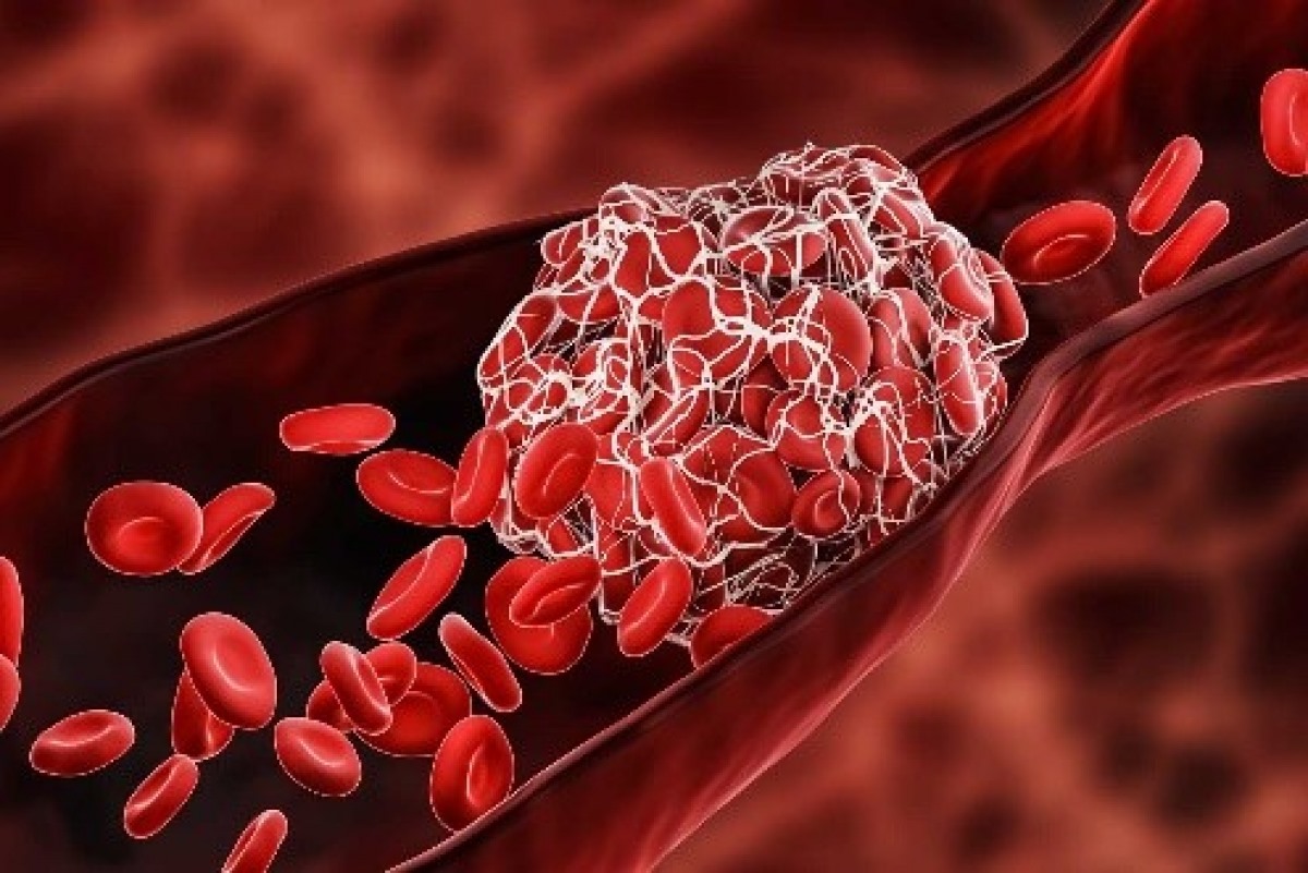 Tìm hiểu được cách thức hình thành các cục máu đông giúp phát triển các phương pháp điều trị hiệu quả.