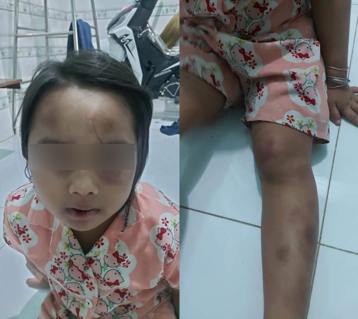 Mặt và chân bé gái bị đánh bầm tím.