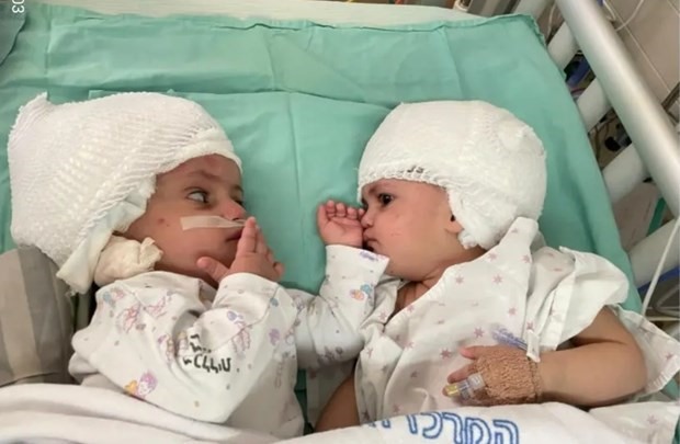 2 bé song sinh được phẫu thuật thành công. (Nguồn: The Jerusalem Post)