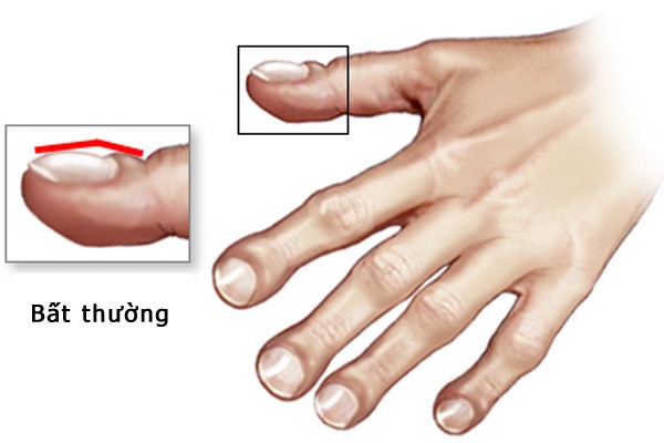 Tình trạng điển hình của người có ngón tay dùi trống