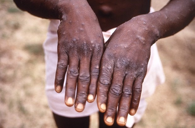 Bệnh nhân mắc bệnh đậu mùa khỉ tại Congo. (Ảnh: AFP/TTXVN)
