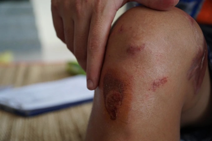 Những vết thương trên cơ thể lao động do té ngã trong cuộc đào tẩu và bị quản lý đánh trong thời gian làm việc tại Campuchia. Nguồn: Dân trí