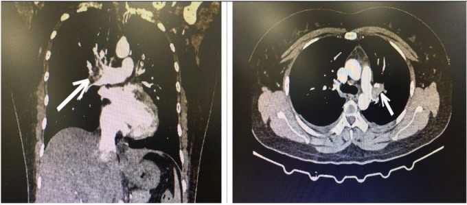 Hình ảnh CT lồng ngực bệnh nhân bị tắc động mạch phổi cấp tính