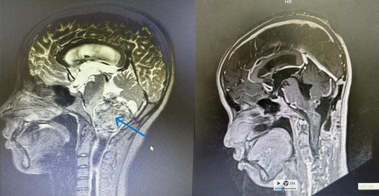 Hình ảnh chụp khối u ở vị trí thân não (bên trái) và sau khi khối u được phẫu thuật loại bỏ (bên phải).Ảnh: BVĐK Tâm Anh.