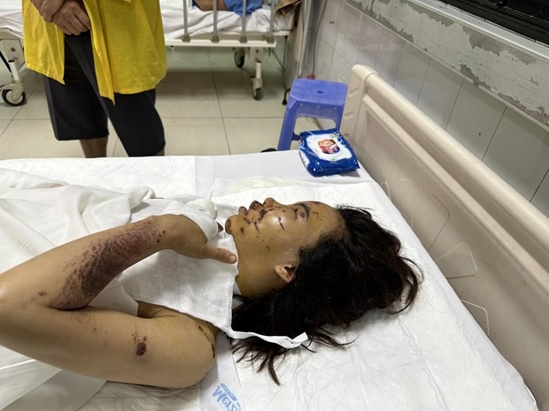 Bệnh nhân bị đa chấn thương nguy hiểm do điện thoại phát nổ khi đang sạc. (Ảnh: PV/Vietnam+)