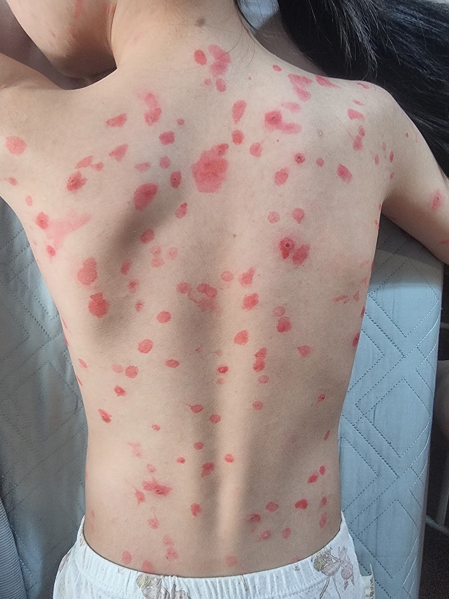 Các nốt ban tròn mọc khắp người của một trẻ em bị mắc thủy đậu ở TP. Đông Hà -Ảnh: H.N